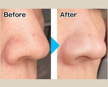 韓国式3D毛穴洗浄